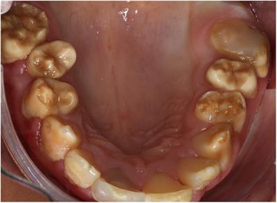 Oral health-related quality of life in Northland Māori children and adolescents with Polynesian amelogenesis imperfecta